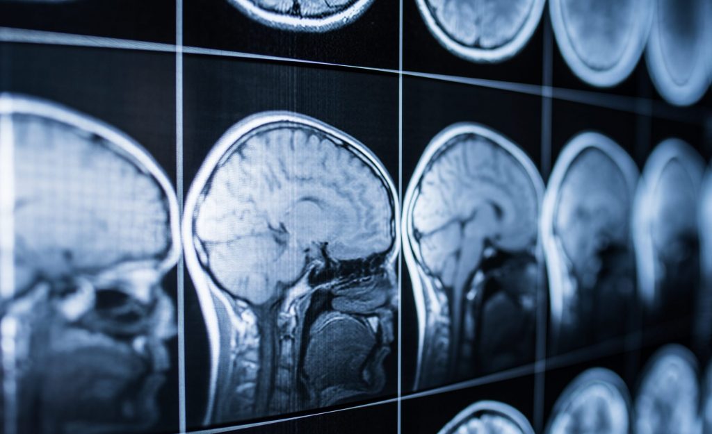 What You Need To Know About PostConcussion Syndrome After A TBI